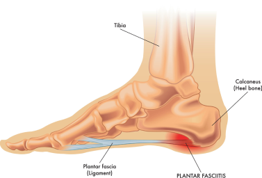 Plantar-fasciitis image