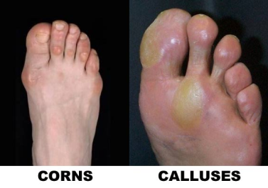 feet with Corns and Calluses